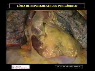 LÍNEA DE REPLIEGUE SEROSO PERICÁRDICO
Dr. JAVIER. HUAMÁN ABREGÚ
 