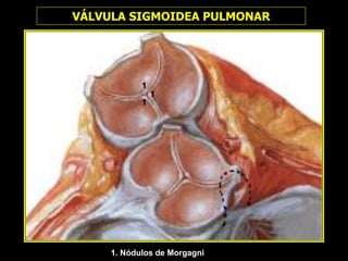 1. Nódulos de Morgagni
2
Dr. JAVIER. HUAMÁN ABREGÚ
VÁLVULA SIGMOIDEA PULMONAR
1
3
1
1
1
 