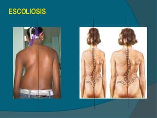 ESCOLIOSIS
 