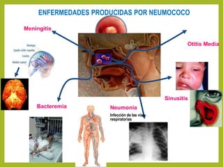 47
Meningitis
Infección de las membranas que
recubren el cerebro
Sinusitis
Otitis Media
Infección de Oído
Neumonía
Infección de las vías
respiratorias
ENFERMEDADES PRODUCIDAS POR NEUMOCOCO
Bacteremia
Neumococo en sangre
 