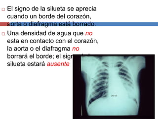  El signo de la silueta se aprecia 
cuando un borde del corazón, 
aorta o diafragma está borrado. 
 Una densidad de agua que no 
esta en contacto con el corazón, 
la aorta o el diafragma no 
borrará el borde; el signo de la 
silueta estará ausente 
 