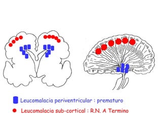 Leucomalacia periventricular : prematuro Leucomalacia sub-cortical : R.N. A Termino 