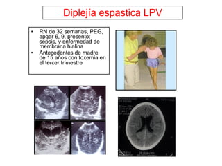 Diplejía espastica LPV RN de 32 semanas, PEG, apgar 6, 9, presento: sepsis, y enfermedad de membrana hialina Antecedentes de madre  de 15 años con toxemia en el tercer trimestre 