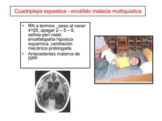Cuadriplejia espastica - encéfalo malacia multiquistica RN a termino , peso al nacer 4100, apagar 2 – 5 – 8, asfixia peri natal, encefalopatía hipoxica isquemica ,ventilación mecánica prolongada Antecedentes materna de DPP 