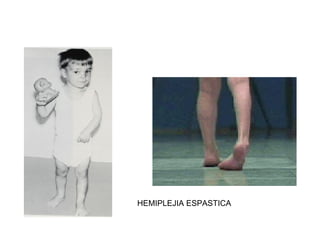 HEMIPLEJIA ESPASTICA 