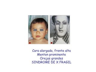 Cara alargada, frente alta Menton prominente Orejas grandes SINDROME DE X FRAGIL 