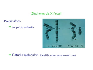 - Diagnostico caryotipo estandar   Estudio molecular   : identificacion de una mutacion Sindrome de X fragil 