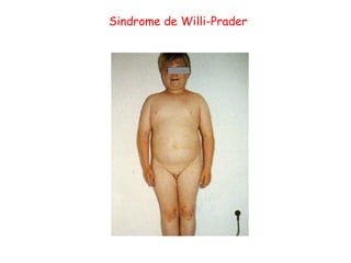Sindrome de Willi-Prader 