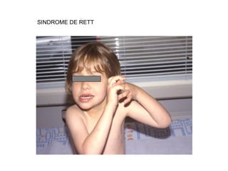SINDROME DE RETT 