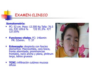 EXAMEN CLINICO Somatometrìa: PC: 52 cm.  Peso: 12.500 Kg  Talla: 76.5 cm. P/E 109.6 % T/E 91.3%  P/T 127.55% Funciones vitales.  FC: 146xmin  FR: 52xmin.  T: 37 Ectoscopìa:  despierta con fascies dismorfica: Macrocefalia, cara tosca, frente abombada, prominencias frontales, nariz ancha y plana, philtrum largo, labios gruesos TCSC:  infiltración cutáneo mucosa difuso 