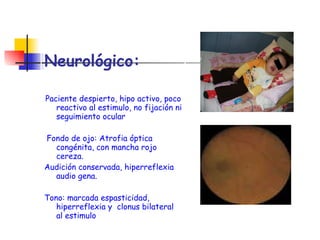 Neurológico:  Paciente despierto, hipo activo, poco reactivo al estimulo, no fijación ni seguimiento ocular Fondo de ojo: Atrofia óptica congénita, con mancha rojo cereza.  Audición conservada, hiperreflexia audio gena. Tono: marcada espasticidad, hiperreflexia y  clonus bilateral al estimulo 