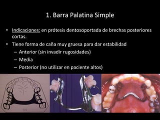 1. Barra Palatina Simple
• Indicaciones: en prótesis dentosoportada de brechas posteriores
cortas.
• Tiene forma de caña m...