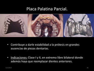 Placa Palatina Parcial.
• Contribuye a darle estabilidad a la prótesis en grandes
ausencias de piezas dentarias.
• Indicac...