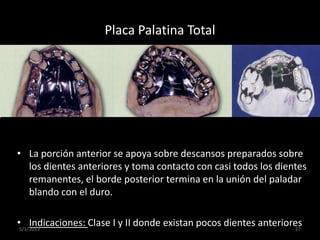 Placa Palatina Total
• La porción anterior se apoya sobre descansos preparados sobre
los dientes anteriores y toma contact...