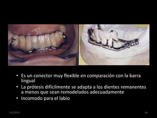 • Es un conector muy flexible en comparación con la barra
lingual
• La prótesis difícilmente se adapta a los dientes reman...