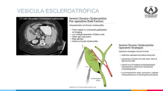 VESICULA ESCLEROATRÓFICA
 