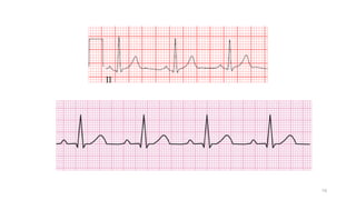 Comprehensive Guide to Electrocardiogram Interpretation and Cardiac ...