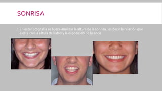 SONRISA
 En esta fotografía se busca analizar la altura de la sonrisa , es decir la relación que
existe con la altura del labio y la exposición de la encía
 
