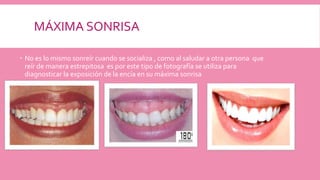 MÁXIMA SONRISA
 No es lo mismo sonreír cuando se socializa , como al saludar a otra persona que
reír de manera estrepitosa es por este tipo de fotografía se utiliza para
diagnosticar la exposición de la encía en su máxima sonrisa
 