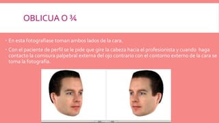 OBLICUA O ¾
 En esta fotografiase toman ambos lados de la cara.
 Con el paciente de perfil se le pide que gire la cabeza hacia el profesionista y cuando haga
contacto la comisura palpebral externa del ojo contrario con el contorno externo de la cara se
toma la fotografía.
 