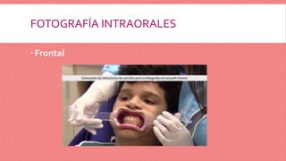 FOTOGRAFÍA INTRAORALES
Frontal
 