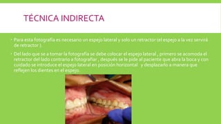 TÉCNICA INDIRECTA
 Para esta fotografía es necesario un espejo lateral y solo un retractor (el espejo a la vez servirá
de retractor ).
 Del lado que se a tomar la fotografía se debe colocar el espejo lateral , primero se acomoda el
retractor del lado contrario a fotografiar , después se le pide al paciente que abra la boca y con
cuidado se introduce el espejo lateral en posición horizontal y desplazarlo a manera que
reflejen los dientes en el espejo.
 