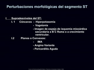 Perturbaciones morfológicas del segmento ST I  Supradesniveles del ST:   I. 1  Cóncavos  -  Hiperpotasemia -  Vagotonía - Imagen de espejo de isquemia miocárdica secundaria a B C Rama o a crecimiento ventricular.  I.2  Planos o Convexos:  -  IMA - Angina Variante - Pericarditis Aguda Curso de Electrocardiografía Básica. Policlínico Universitario Vedado. 2006. 
