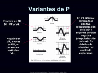 Variantes de P Curso de Electrocardiografía Básica. Policlínico Universitario Vedado. 2006. Positiva en DI; DII; VF y V6.  Negativa en VR, a veces en DIII, en corazones  verticales: VL .  En V1 difásica: primera fase positiva (despolarización de la AD) / segunda porción negativa (despolarización de la AI). Es debido a la situación del electrodo explorador. 