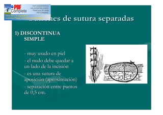 Patrones de sutura separadas
1) DISCONTINUA
    SIMPLE

  - muy usado en piel
  - el nudo debe quedar a
  un lado de la incisión
  - es una sutura de
  aposición (aproximación)
  - separación entre puntos
  de 0,5 cm.
 