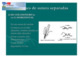 Patrones de sutura separadas
2) DE COLCHONERO (o
   en U) HORIZONTAL

- Es una sutura de tensión
- Comienza en un lado
  (derecho), termina (anuda) en
  mismo lado (derecho)
- Evitar eversión, sólo
  afrontamiento
- Usada en piel
- Separación, 0.5 cm.
 