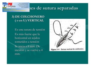 Patrones de sutura separadas
3) DE COLCHONERO
   ( o en U) VERTICAL

- Es una sutura de tensión
- Es más fuerte que la
  horizontal en tejidos
  sometidos a tensión
- Se inicia a 8 mm. De
  incisión y se vuelve a 4
  mm.
 