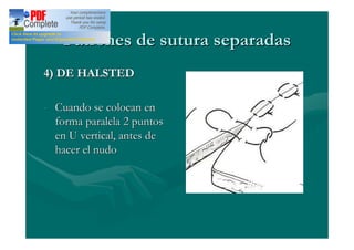Patrones de sutura separadas
4) DE HALSTED

- Cuando se colocan en
  forma paralela 2 puntos
  en U vertical, antes de
  hacer el nudo
 