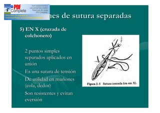 Patrones de sutura separadas
5) EN X (cruzada de
   colchonero)

- 2 puntos simples
  separados aplicados en
  unión
- Es una sutura de tensión
- De utilidad en muñones
  (cola, dedos)
- Son resistentes y evitan
  eversión
 