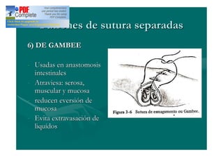Patrones de sutura separadas
6) DE GAMBEE

- Usadas en anastomosis
  intestinales
- Atraviesa: serosa,
  muscular y mucosa
- reducen eversión de
  mucosa
- Evita extravasación de
  liquídos
 