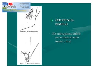 1) CONTINUA
   SIMPLE

- En subcutáneo, cubrir
    (esconder) el nudo
    inicial y final
 
