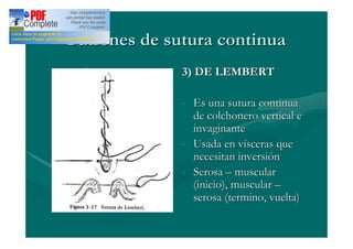 Patrones de sutura continua
              3) DE LEMBERT

              - Es una sutura continua
                de colchonero vertical e
                invaginante
              - Usada en vísceras que
                necesitan inversión
              - Serosa muscular
                (inicio), muscular
                serosa (termino, vuelta)
 