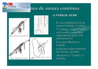 Patrones de sutura continua
               6) PARKER- KERR

               - Es una combinación de las
                 suturas Cushing y Lembert
               - 1º Cushing y luego 2º cubrir
                 con Lembert (se prefiere
                 orden inverso para evitar
                 contaminación)
               - Usar pinza Rochester -
                 Carmalt
               - Usada para cerrar muñones
                 de vísceras y de útero
               - Alternativa: 1º Conell y 2º
                 Cushing
 