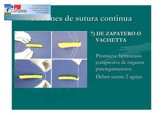 Patrones de sutura continua
               7) DE ZAPATERO O
                  VACHETTA

               - Promueve hemostasis
                 compresiva de órganos
                 parenquimatosos
               - Deben usarse 2 agujas
 