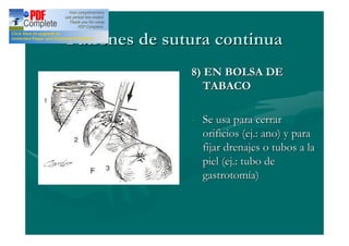Patrones de sutura continua
               8) EN BOLSA DE
                  TABACO

               - Se usa para cerrar
                 orificios (ej.: ano) y para
                 fijar drenajes o tubos a la
                 piel (ej.: tubo de
                 gastrotomía)
 