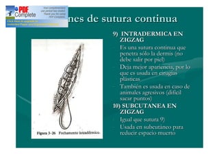 Patrones de sutura continua
              9) INTRADERMICA EN
                 ZIGZAG
              - Es una sutura continua que
                 penetra sólo la dermis (no
                 debe salir por piel)
              - Deja mejor apariencia, por lo
                 que es usada en cirugías
                 plásticas
              - También es usada en caso de
                 animales agresivos (difícil
                 sacar puntos)
              10) SUBCUTANEA EN
                 ZIGZAG
              - Igual que sutura 9)
              - Usada en subcutáneo para
                 reducir espacio muerto
 