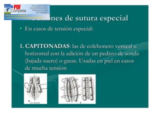 Patrones de sutura especial
  En casos de tensión especial:

1. CAPITONADAS: las de colchonero vertical u
   horizontal con la adición de un pedazo de sonda
   (bajada suero) o gasas. Usadas en piel en casos
   de mucha tensión
 