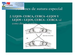 Patrones de sutura especial
2. LEJOS- CERCA, CERCA LEJOS Y
  LEJOS LEJOS, CERCA - CERCA: tal
  como dice su nombre
 
