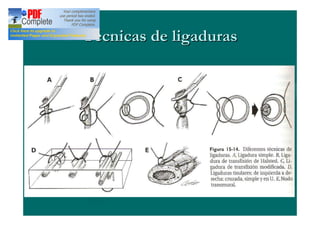 Técnicas de ligaduras
 