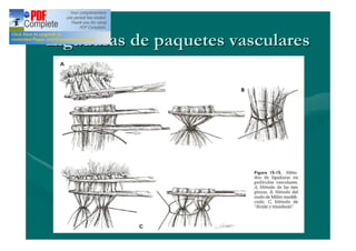 Ligaduras de paquetes vasculares
 