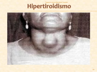 Trastorno de la Glandula Tiroides




                                    10
 