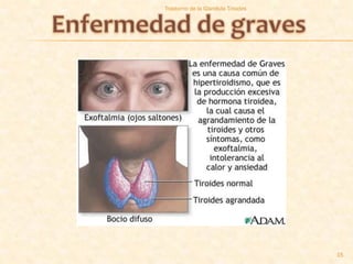 Trastorno de la Glandula Tiroides




                                    15
 
