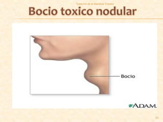 Trastorno de la Glandula Tiroides




                                    20
 