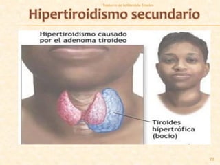 Trastorno de la Glandula Tiroides




                                    23
 