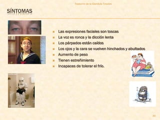 Trastorno de la Glandula Tiroides


SÍNTOMAS


              Las expresiones faciales son toscas
              La voz es ronca y la dicción lenta
              Los párpados están caídos
              Los ojos y la cara se vuelven hinchados y abultados
              Aumento de peso
              Tienen estreñimiento
              Incapaces de tolerar el frío.




                                                                     30
 