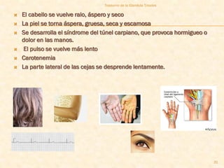 Trastorno de la Glandula Tiroides

   El cabello se vuelve ralo, áspero y seco
   La piel se torna áspera, gruesa, seca y escamosa
   Se desarrolla el síndrome del túnel carpiano, que provoca hormigueo o
    dolor en las manos.
    El pulso se vuelve más lento
   Carotenemia
   La parte lateral de las cejas se desprende lentamente.




                                                                            31
 